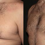 Male Breast Reduction 4