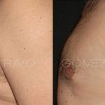 Male Breast Reduction 3