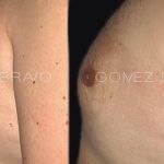 Male Breast Reduction 1