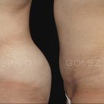 Abdominoplasty 20