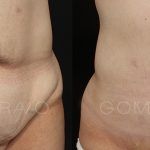 Abdominoplasty 19