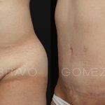 Abdominoplasty 18