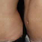 Abdominoplasty 17