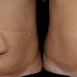 Abdominoplasty 16