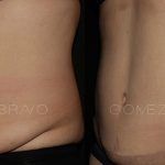 Abdominoplasty 15