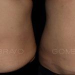 Abdominoplasty 14