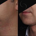 Double Chin Correction 4