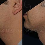 Double Chin Correction 3