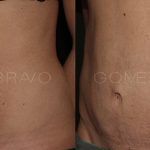 Abdominoplasty 13