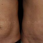 Abdominoplasty 11