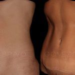 Abdominoplasty 8