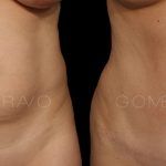 Abdominoplasty 6