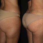 Liposuction 7