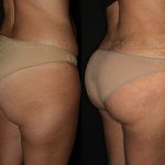 Liposuction 7