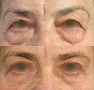 Eyelid Surgery 8