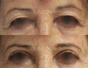 Eyelid Surgery 6