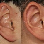 Otoplasty 11