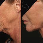Facelift and Neck Lift 2