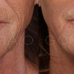 Facelift and Neck Lift 1