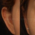 Otoplasty 5