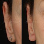 Otoplasty 4