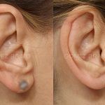 Otoplasty 2