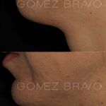 Chin Augmentation 4