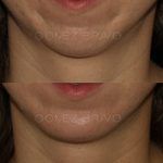 Chin Augmentation 3