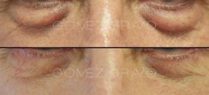 Eyelid Surgery 17