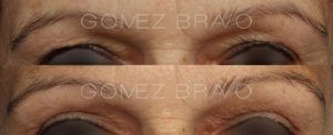 Eyelid Surgery 12