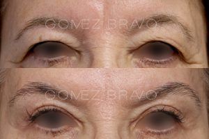 Eyelid Surgery 10