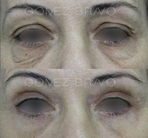 Eyelid Surgery 9