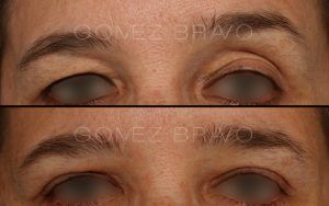 Eyelid Surgery 3