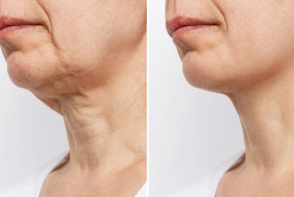 Before and after photo of a woman who underwent a neck lift.