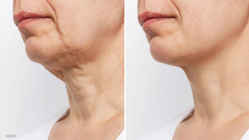 Before and after photo of a woman who underwent a neck lift.