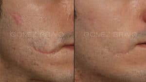 RECONSTRUCCIÓN FACIAL 18