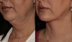RECONSTRUCCIÓN FACIAL 19