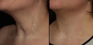 RECONSTRUCCIÓN FACIAL 16